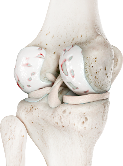 Артроз, остеоартроз