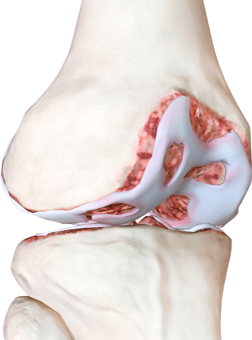 Остеоартрит